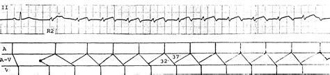 第125例 交界性心搏引起慢快型房室结折返性心动过速-心律失常心电图分析-医学