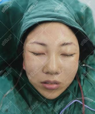 上海九院丁伟面部小切口拉皮手术30天恢复照片，花费8万多,童颜术对比照-8682赴韩整形网