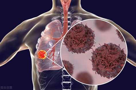 如何识别肺癌早期症状及饮食调理-百度经验