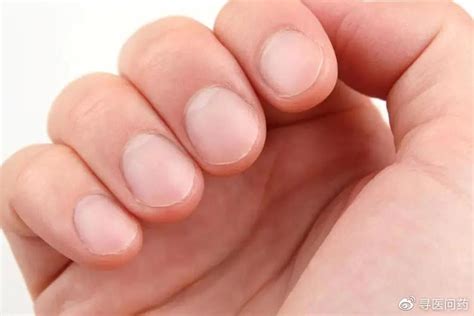 几大类型灰指甲的症状-灰指甲症状-复禾健康