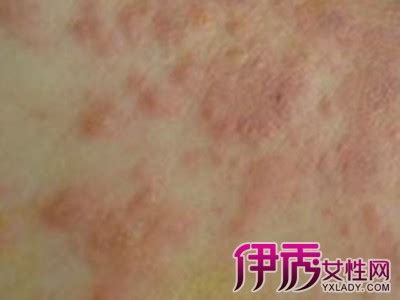 药物过敏皮疹图片
