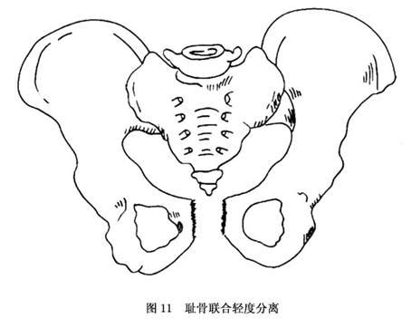 测量骨盆演示图图片