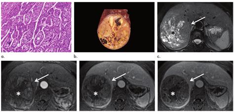 【佳文共赏】第4期：《Radiology》多期动态增强MR有助于识别肝癌组织学亚型_研究