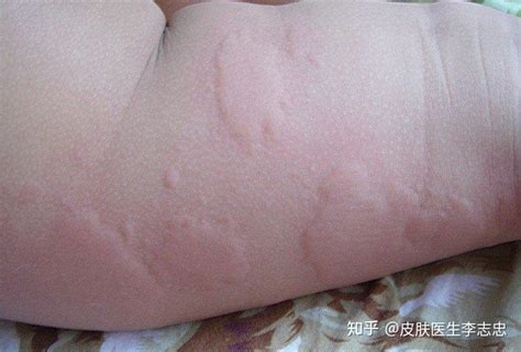 荨麻疹患者需要注意什么呢_荨麻疹_北京京城皮肤医院(北京医保定点机构)