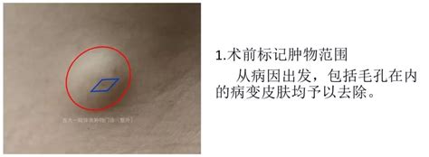 臀部脂肪瘤图片