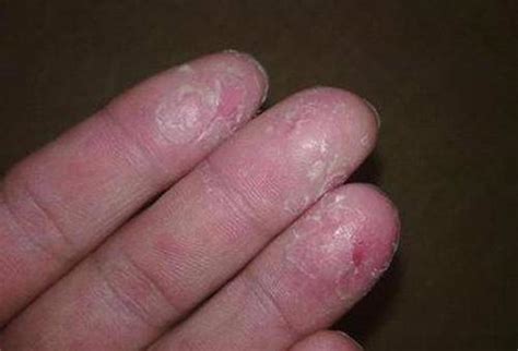 手指水泡型湿疹图片 (5)_有来医生