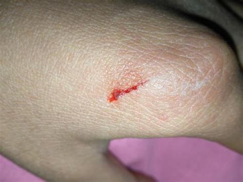 小伤口导致截肢……这个3岁孩子身上到底发生了什么_手指
