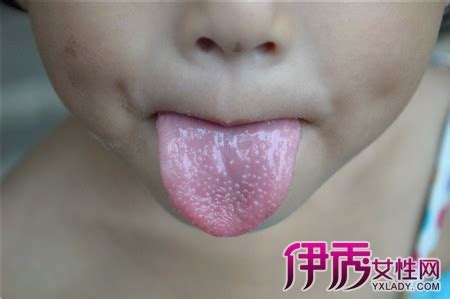 【小孩舌头起泡怎么办】【图】小孩舌头起泡怎么办？ 6个方法帮助你(3)_伊秀健康|yxlady.com