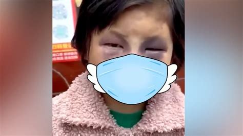 警方辟谣小女孩被同学打成熊猫眼：偷钱被妈妈打的_凤凰网视频_凤凰网