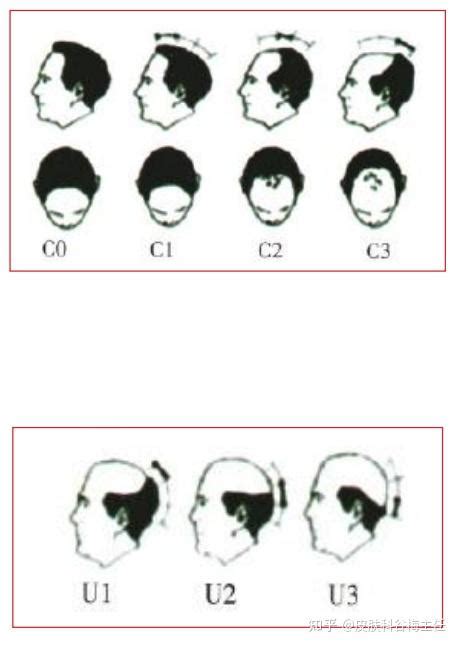 7个治疗脱发、秃发的效验单方，全是干货 - 知乎
