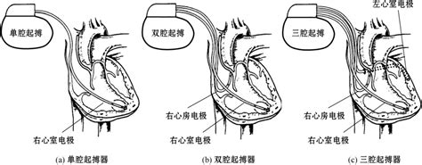 心脏起搏器基础知识 - 知乎