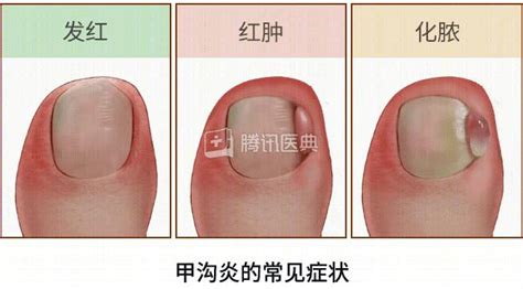 婴儿甲沟炎图片