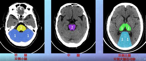 脑卒中临床评估量表教学视频：ASPECTS评分量表_区域_解剖图_全网