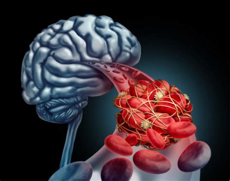 脑卒中和脑溢血、脑梗、脑血栓有什么区别和前兆症状
