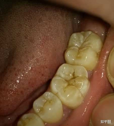 牙齿断裂临时修复一篇----牙医连海-牙医连海 大连的连的博客-KQ88口腔博客