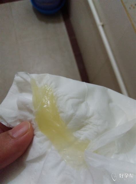 血性分泌物图片