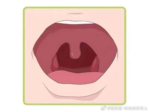 腭咽弓发炎图片