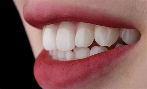 DSD口腔美学-牙齿美学修复案例分享！_贴面_管理_患者