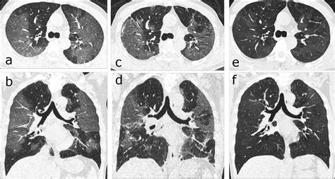 肺移植术后1年出现肺部阴影，排斥反应？感染？现有病原学证据均无法解释新发病变，NGS报告中的关键信息是怎样被捞出的？-å­¦æœ¯-呼吸界