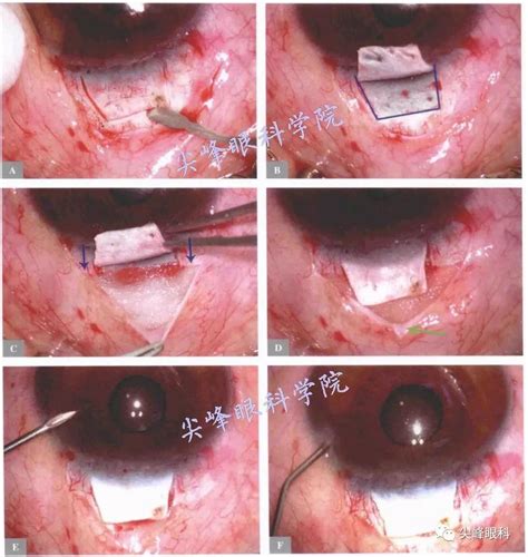 EX-PRESS青光眼微型引流器植入手术 part01 | 《图解青光眼手术操作与技巧》042_结膜