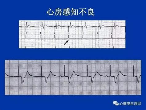 二、起搏器心电图的表现-临床心电图学及-医学