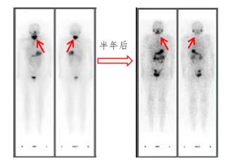 国际甲状腺知识宣传周丨解密甲癌术后为何还需放射性碘治疗 - 中国核技术网