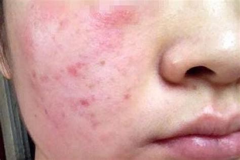 为什么总是发生过敏性荨麻疹？提示：日常做好3点，皮肤越来越好