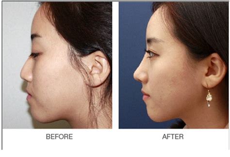 5步改善鼻翼宽、塌鼻梁、变美拥有高鼻梁 - 知乎