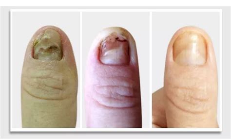 【灰指甲图片初期】【图】小知识灰指甲图片初期 几个有效方法助你提前预防烦恼_伊秀健康|yxlady.com