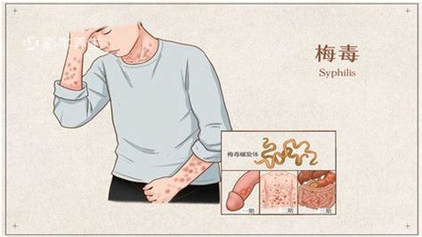怎么诊断一期梅毒_梅毒_北京京城皮肤医院(北京医保定点机构)