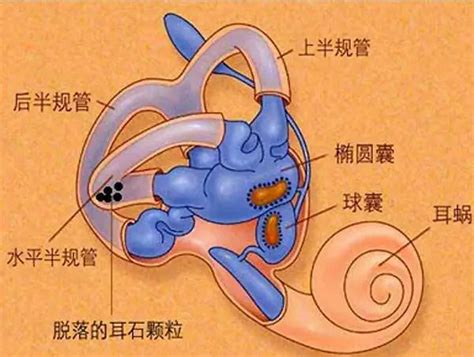 耳石症图片