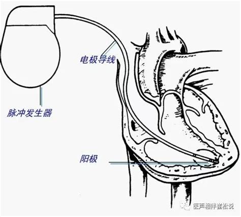 【专家讲堂】张海澄教授系列之二十：起搏器植入术后应注意什么？