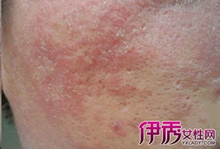 脂溢性皮炎是如何引起的_皮炎_北京京城皮肤医院(北京医保定点机构)