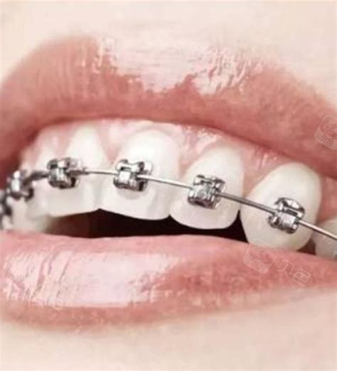 牙齿矫正，牙套如何选择？隐形？金属？陶瓷？ - 知乎