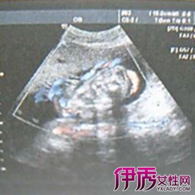 【怎么看b超图】【图】怀孕了怎么看b超图 B超单告诉你宝宝的性别(3)_伊秀健康|yxlady.com