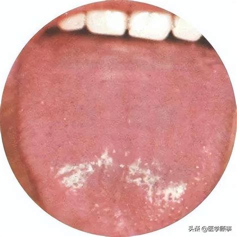 舌头增生轻度图片