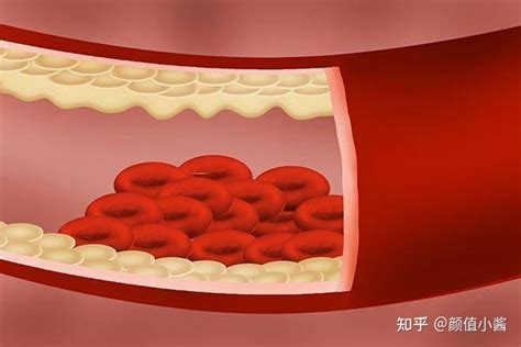 下肢静脉血栓图片