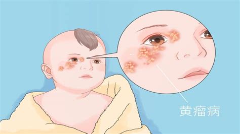 黄瘤病图片