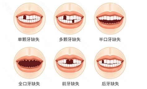 去武汉平头牙匠口腔做种植牙效果好价格还不贵,附用户评价,种植牙-8682赴韩整形网