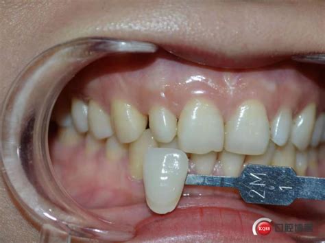 什么叫半固定种植牙?就是杆卡及球帽式覆盖义齿可自由摘戴,种植牙-8682赴韩整形网