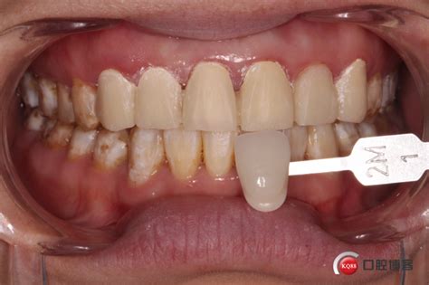 上前牙冠折氧化锆修复-石家庄牙医康朝辉的博客-KQ88口腔博客