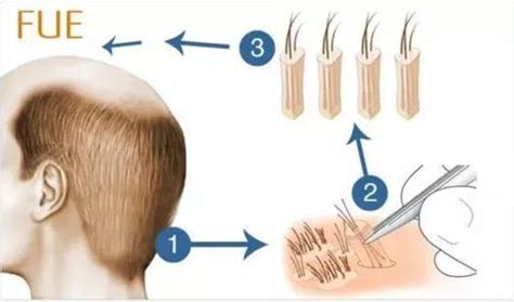 拿什么拯救你的头发？昆明新生植发：3D植发技术效果广受认可_证券之星