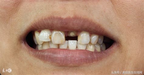 牙齿断了一半怎么补比较好（牙磕断了一半怎么办？牙缺损要如何修复？） | 说明书网