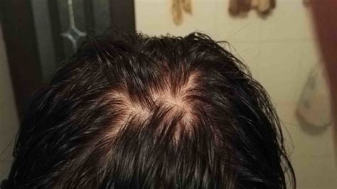 内分泌失调导致脱发怎么治疗,内分泌失调引起的白发怎么办 - 知乎