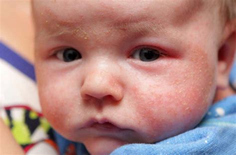 怎么分辨宝宝是不是出疹性疾病 宝宝出疹肌肤如何护理 _八宝网