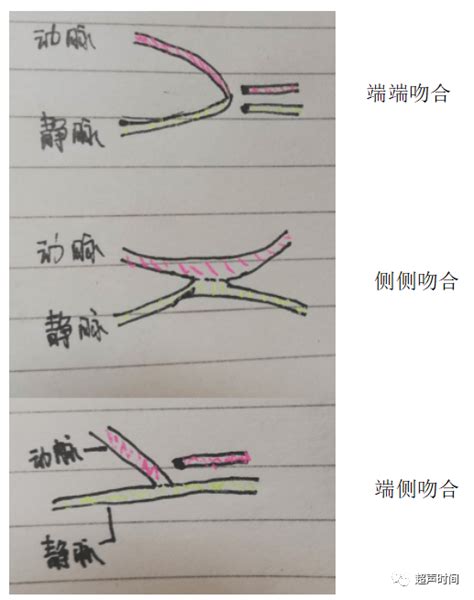 动静脉内瘘图片