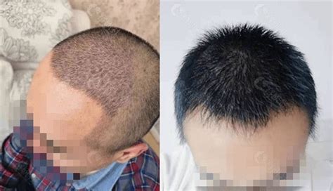 江苏植发案例-种植头发-对比效果图-发友网