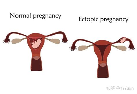 生化妊娠是什么意思（生化妊娠是什么？为什么我会出现生化妊娠？） | 说明书网