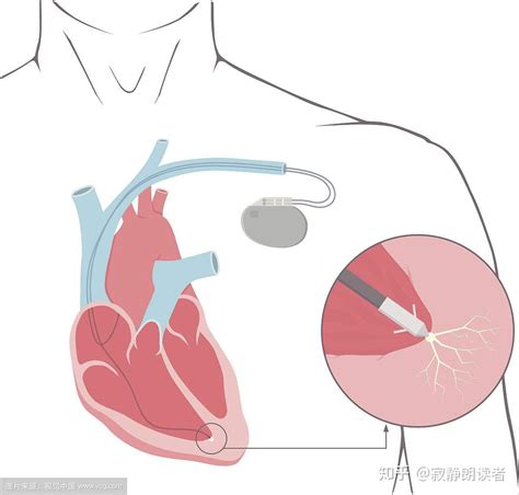 零”的突破】我院首例永久性心脏起搏器植入手术成功开展-最新动态-番禺区中医院