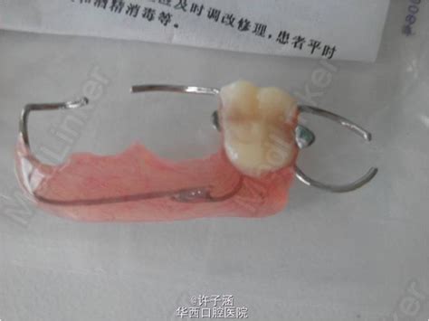 可摘局部义齿修复-医联